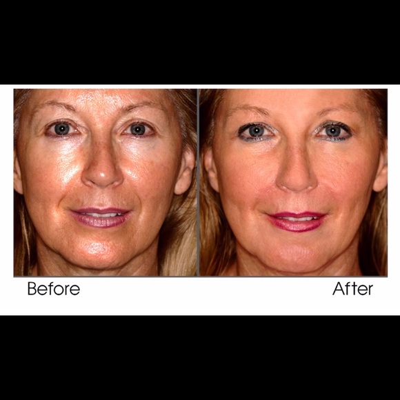 Intensive Cell Renewal Lifting System - Picture 7 of 11